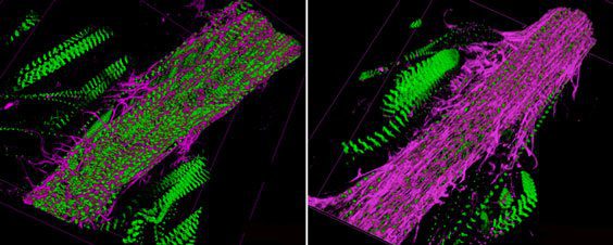 Imagem da pesquisa. À esquerda, vasos cardíacos de moscas normais, com pouca fibrose (em rosa). Já na direita, a fibrose domina o vaso de uma mosca alimentada com dieta rica em sacarose. Crédito: Sanford-Burnham Medical Research Institute.