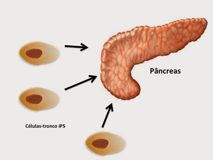 dr carlos couri pancreas diabetes