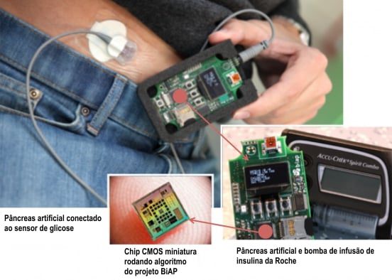 pancreas artificial diabetes