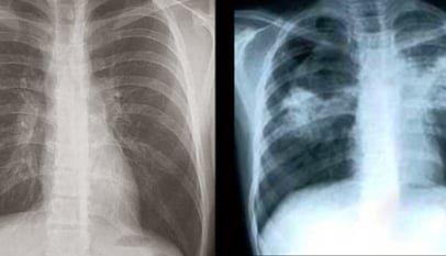 diabetes tuberculose carlos couri