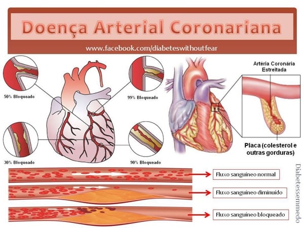 doenca arterial coronariana diabetes