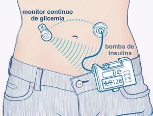 pancreas artificial esquema