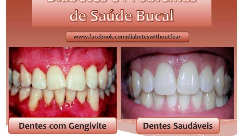 diabetes sem medo problemas de saude bucal
