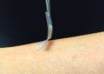 foto- diabetes - adesivo de insulina 2015